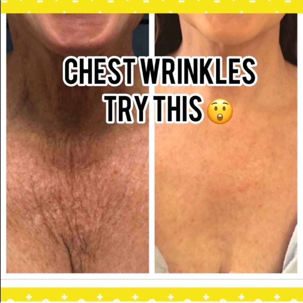 Chest wrinkle try this